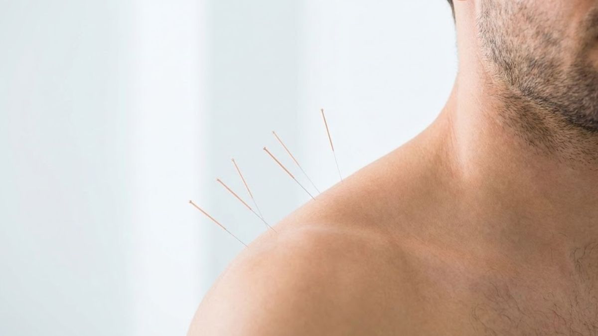Acupuncture needles applied to a patient to help with stress relief.